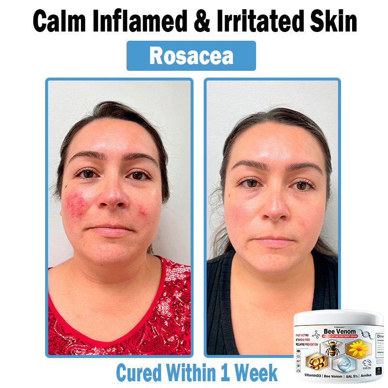 TODAHOF™ Bee Venom Multi-Symptom Skin Treatment Cream (👨⚕ACD RECOMMENDS)🇦🇺