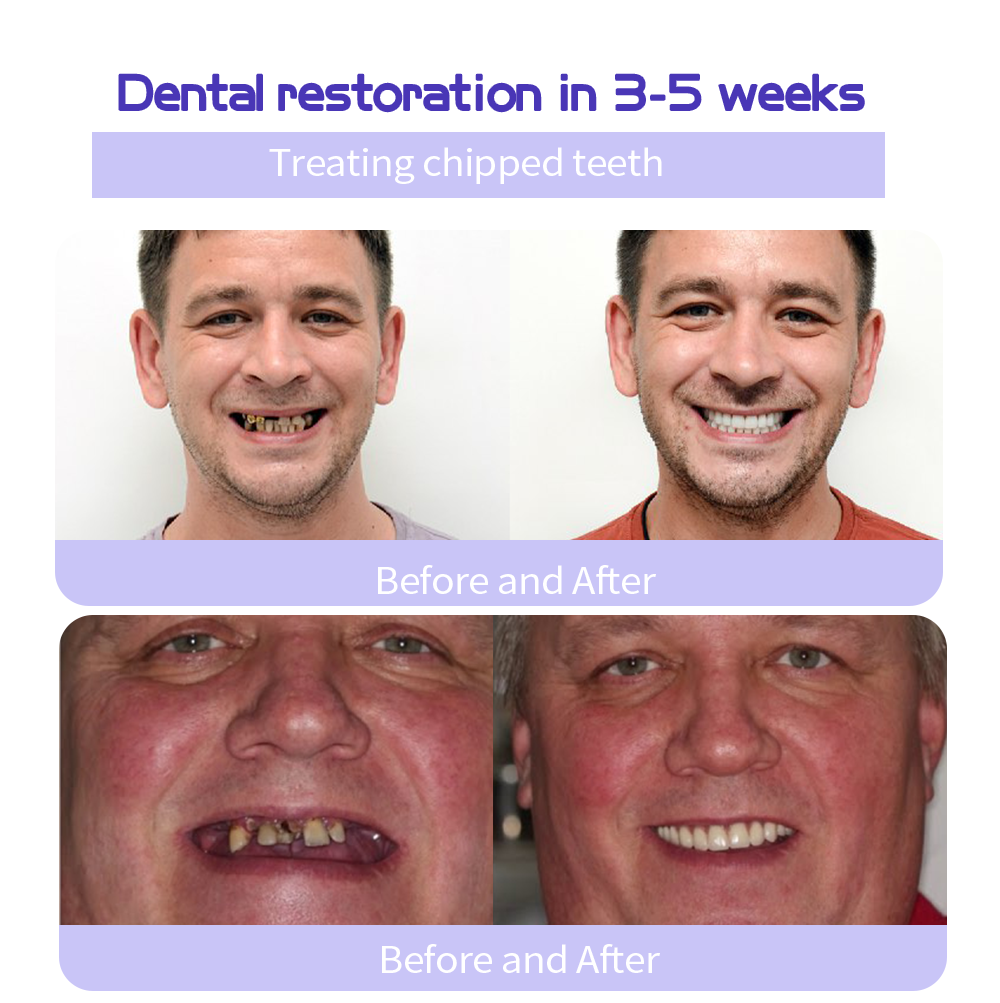 Cvreozโข (ADA recommended)Teeth Restoration Mineral Powder(๐๐๐ข๐ฆ๐ข๐ญ๐๐ ๐ญ๐ข๐ฆ๐ ๐๐ข๐ฌ๐๐จ๐ฎ๐ง๐ญ ๐๐๐ฌ๐ญ ๐๐ ๐ฆ๐ข๐ง๐ฎ๐ญ๐๐ฌ๐) โ๏ธ