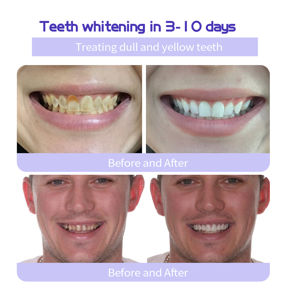 Cvreozโข (ADA recommended)Teeth Restoration Mineral Powder(๐๐๐ข๐ฆ๐ข๐ญ๐๐ ๐ญ๐ข๐ฆ๐ ๐๐ข๐ฌ๐๐จ๐ฎ๐ง๐ญ ๐๐๐ฌ๐ญ ๐๐ ๐ฆ๐ข๐ง๐ฎ๐ญ๐๐ฌ๐) โ๏ธ