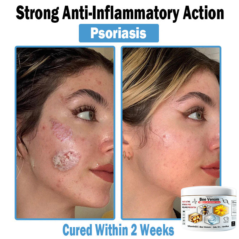 TODAHOF™ Bee Venom Multi-Symptom Skin Treatment Cream (👨⚕ACD RECOMMENDS)🇦🇺