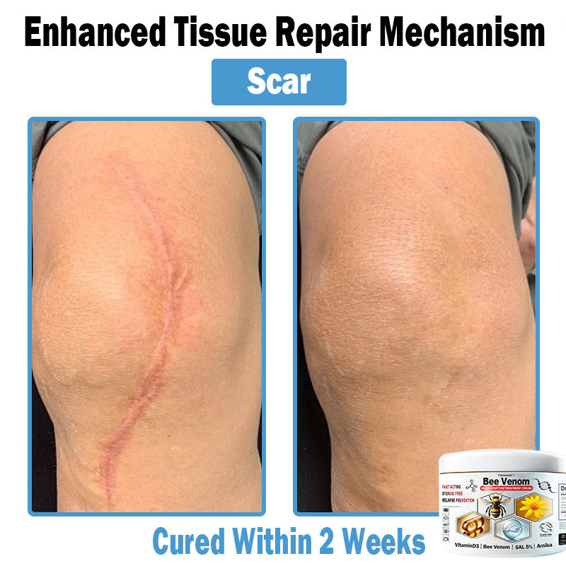 TODAHOF™ Bee Venom Multi-Symptom Skin Treatment Cream (👨‍⚕ACD RECOMMENDS)🇦🇺
