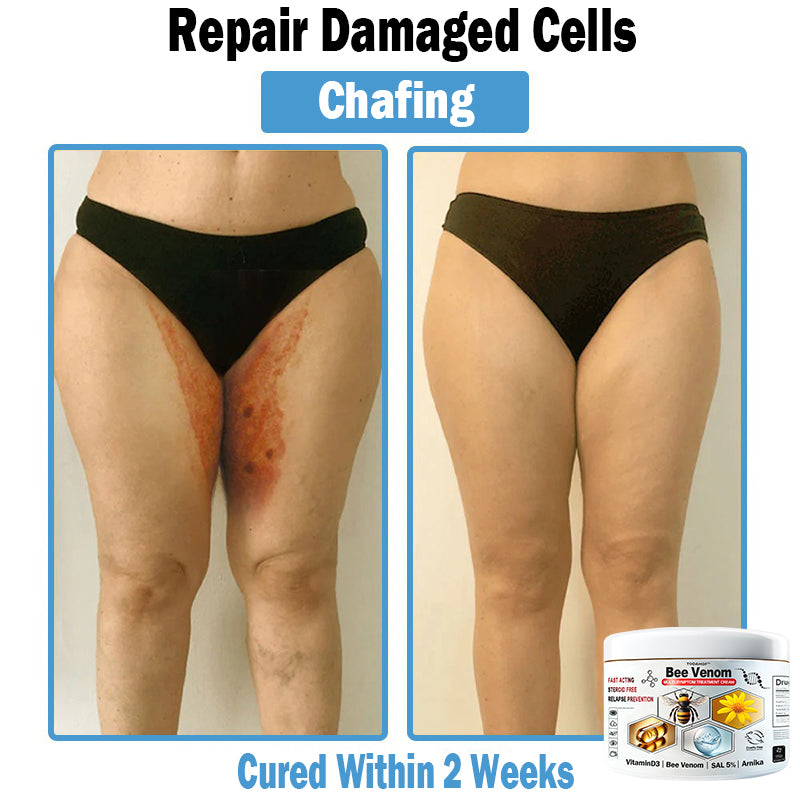 TODAHOF™ Bee Venom Multi-Symptom Skin Treatment Cream (👨‍⚕ACD RECOMMENDS)🇦🇺