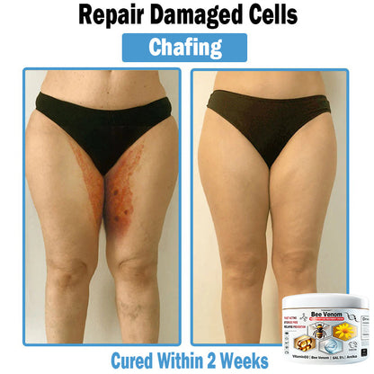 TODAHOF™ Bee Venom Multi-Symptom Skin Treatment Cream (👨‍⚕ACD RECOMMENDS)🇦🇺