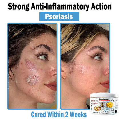 TODAHOF™ Bee Venom Multi-Symptom Skin Treatment Cream (👨‍⚕ACD RECOMMENDS)🇦🇺